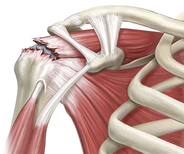 torn-rotator-cuff